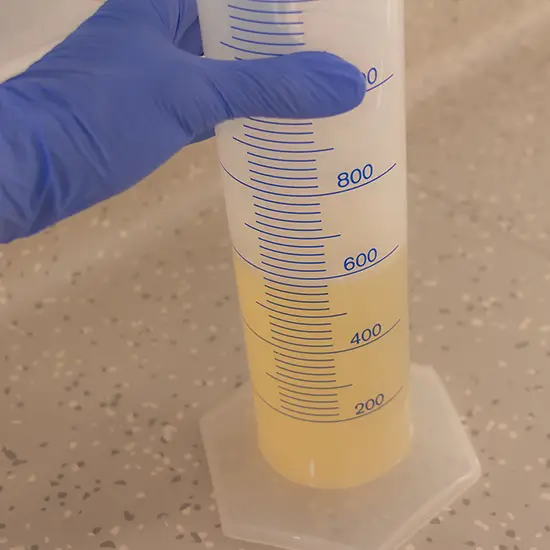 Urine For Fat Globules